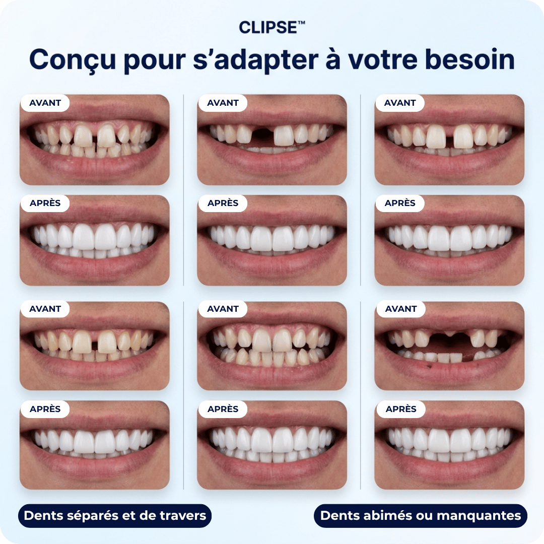 Facettes dentaires Clipse®