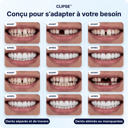 Facettes dentaires Clipse®