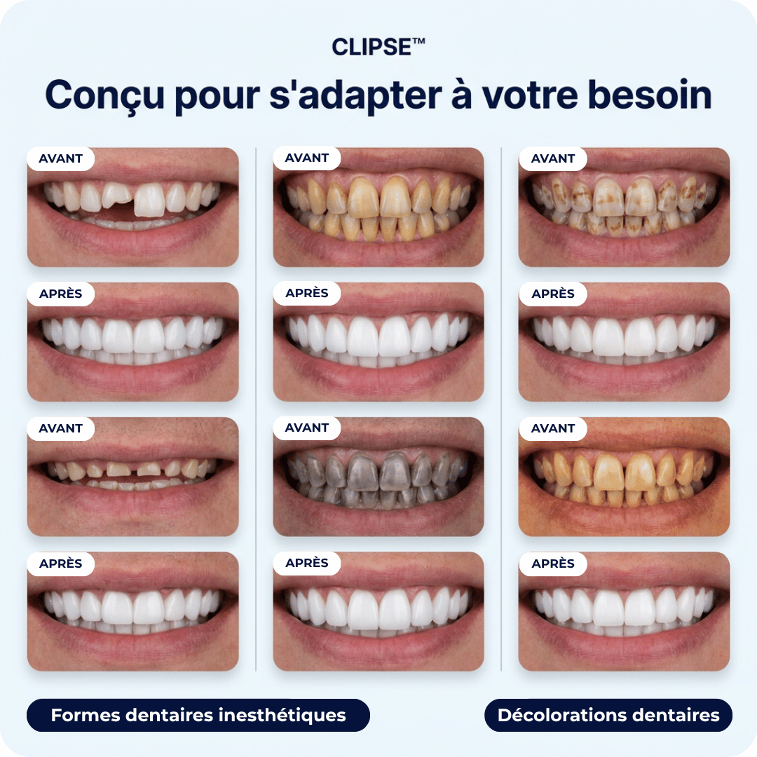 Facettes dentaires Clipse®