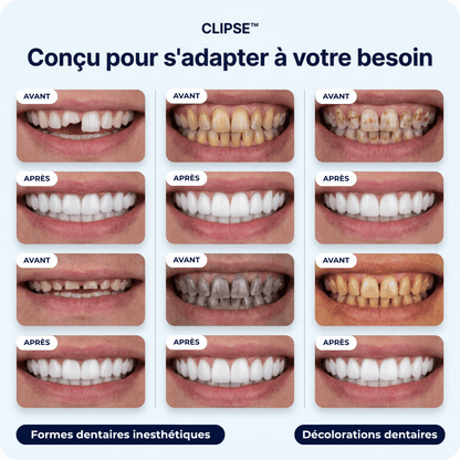 Facettes dentaires Clipse®