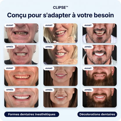 Facettes dentaires Clipse®