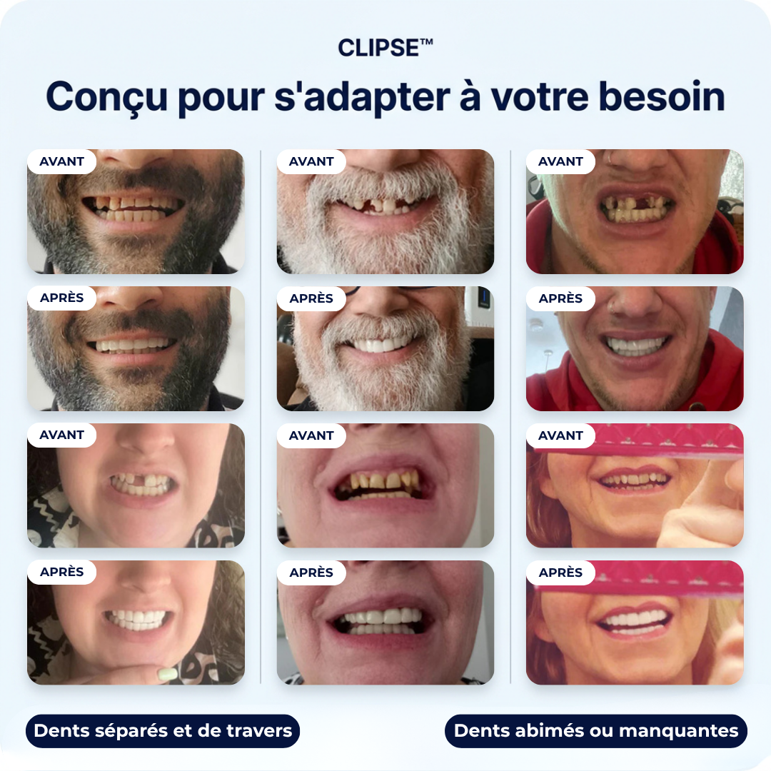 Facettes dentaires Clipse®